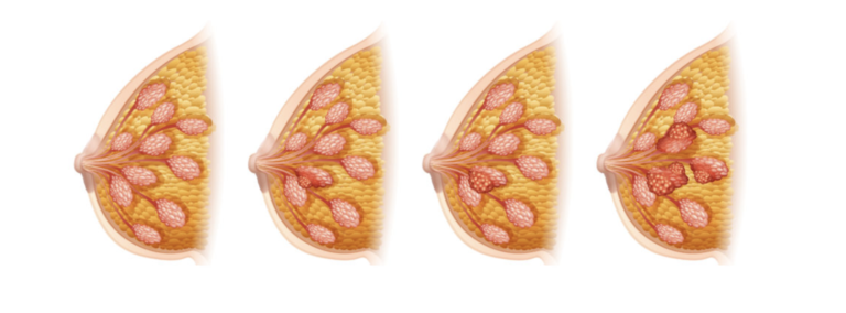 Sacituzumab govitecan rimborsabile per cancro della mammella triplo negativo metastatico e refrattario