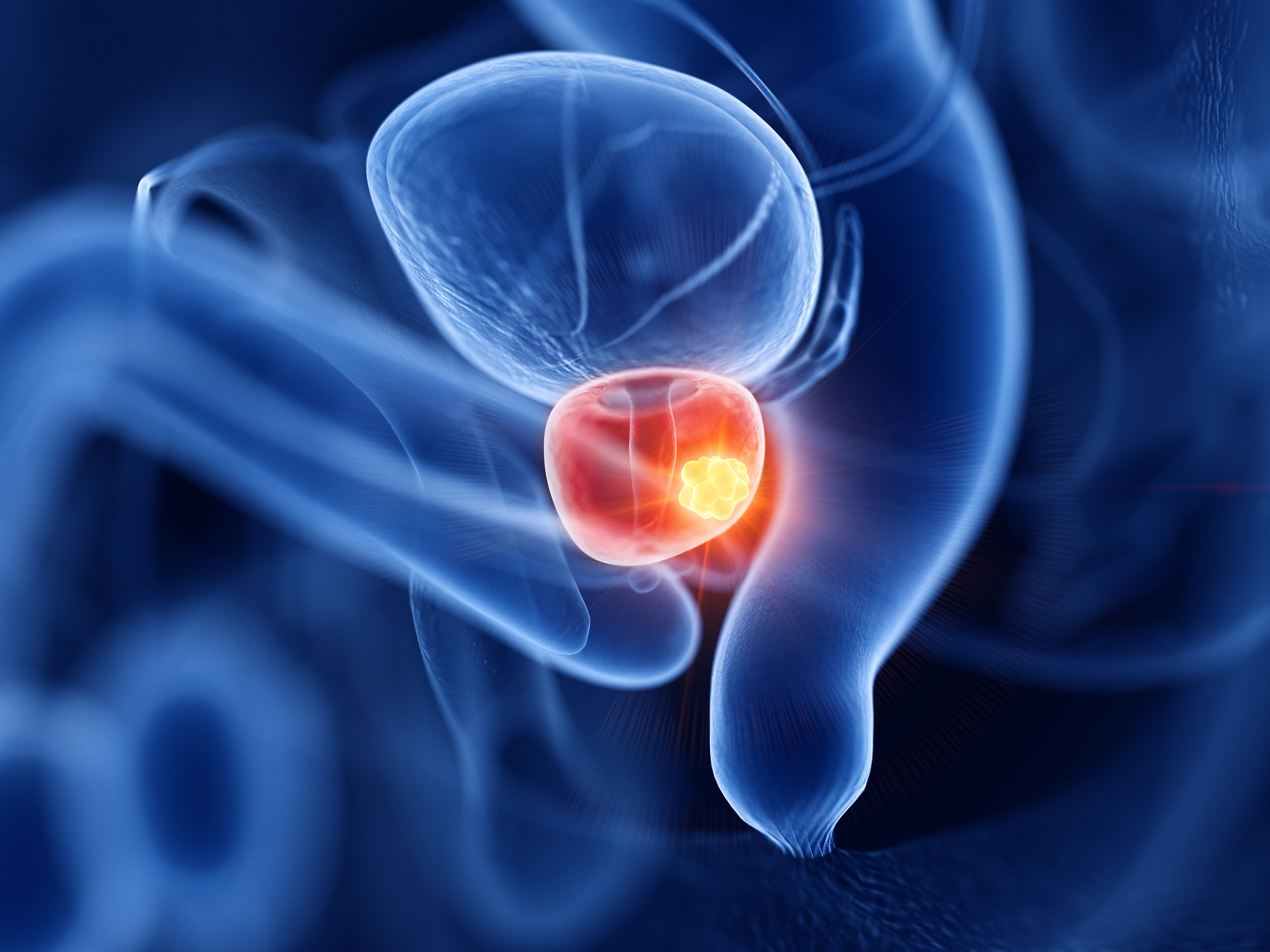 Tumore della prostata, la sfida dei radioligandi