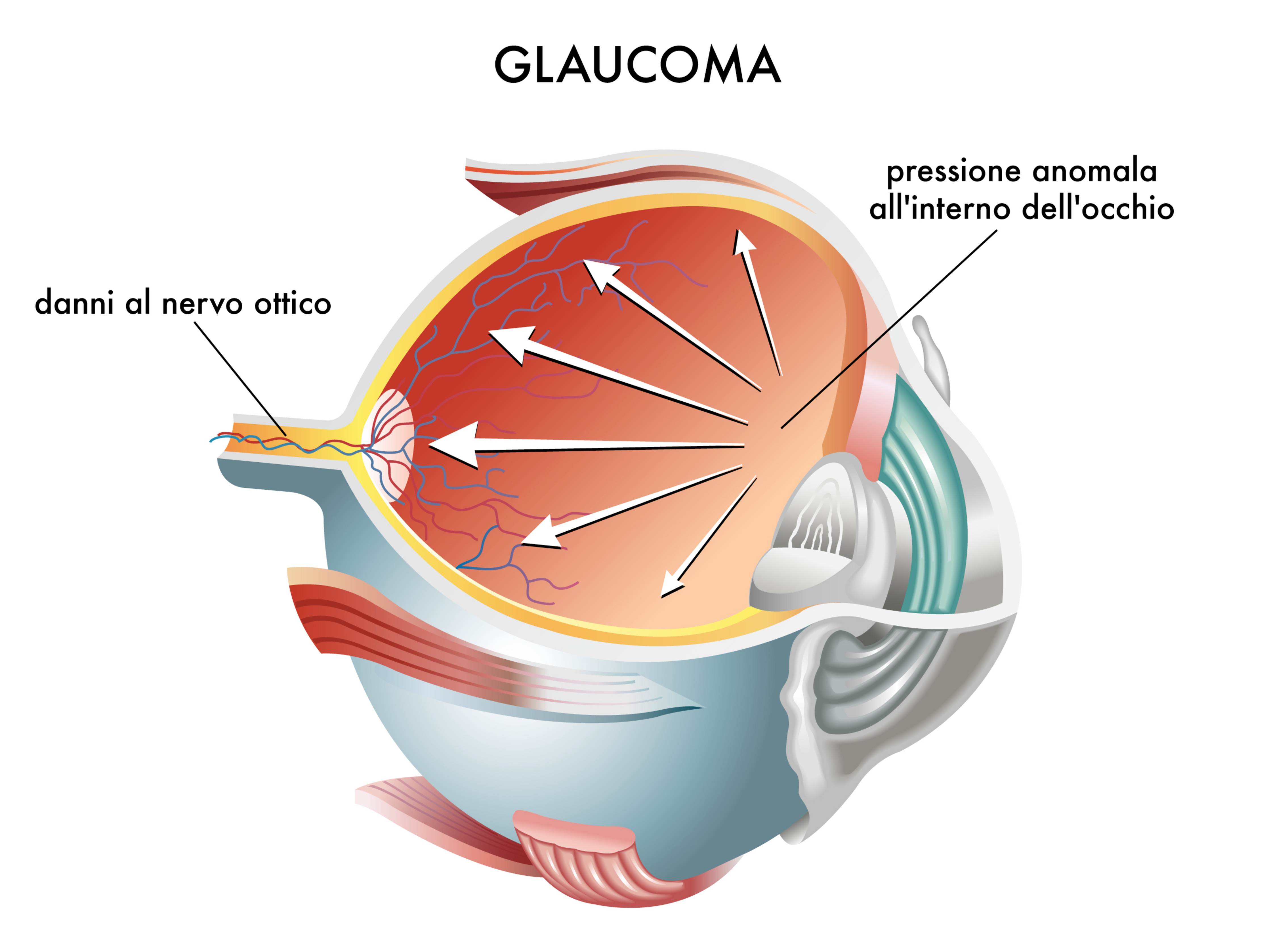 Glaucoma, la citicolina migliora la qualità di vita